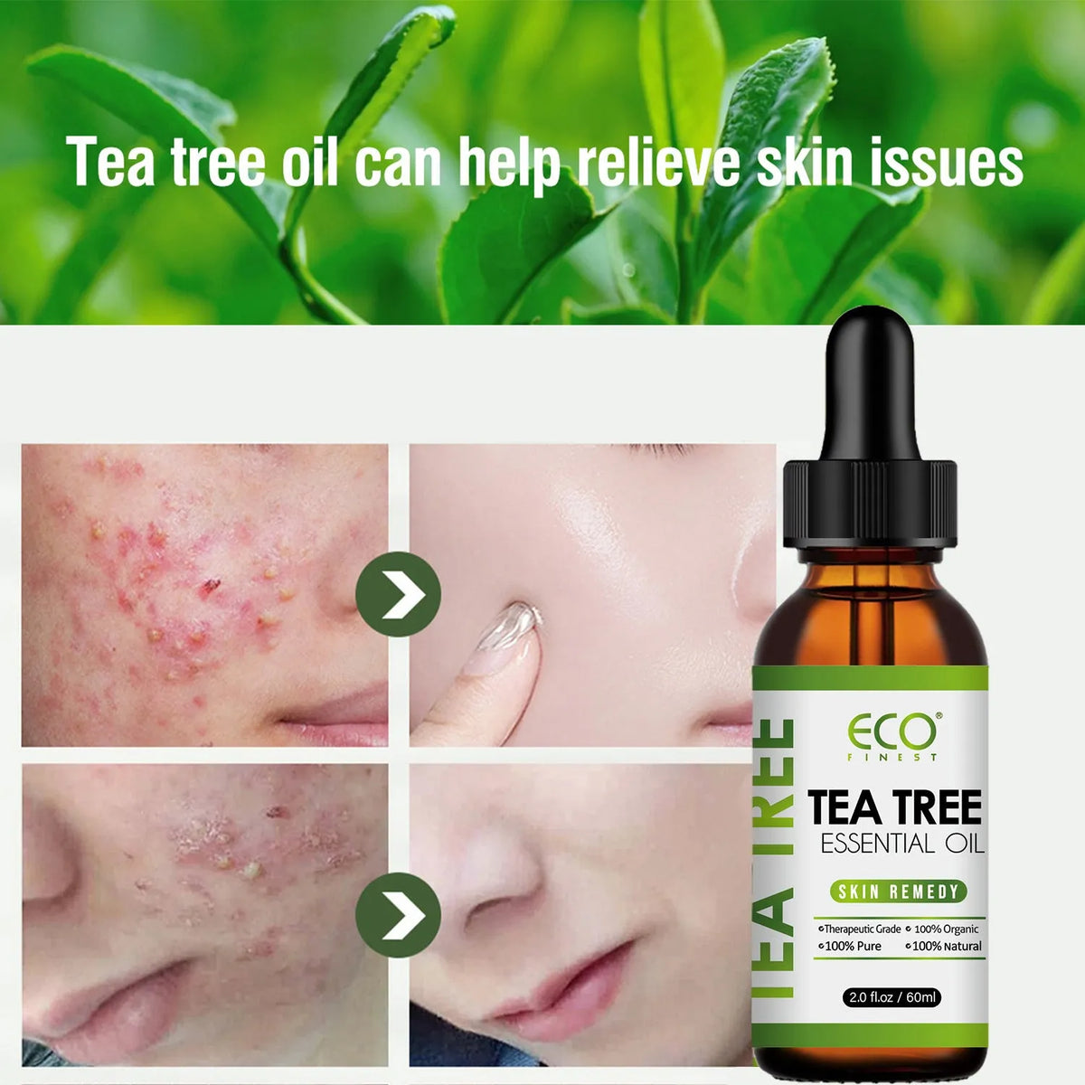 60ml bottle of Tea Tree Essential Oil for massage and acne fade treatment.